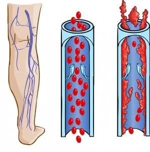 Ako vyzerajú normálne žily a žily s kŕčovými žilami