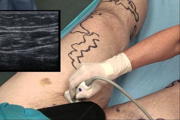 diagnostika kŕčových žíl u mužov