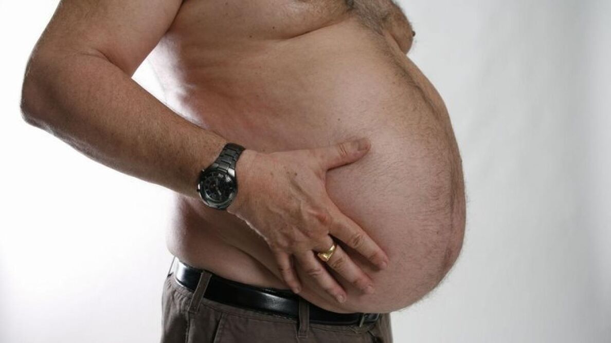 obezita ako príčina rozvoja kŕčových žíl