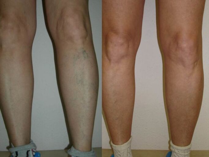 nohy pred a po laserovom ošetrení kŕčových žíl