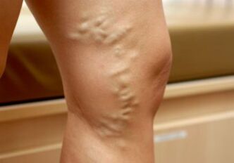 Kŕčové žily na ženských nohách